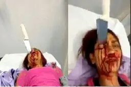 نجات معجزه آسا زنی با یک چاقو در پیشانی +عکس