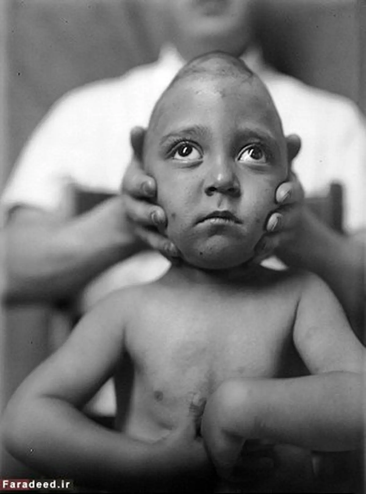 اولین بیماران جراحی مغز و اعصاب + تصاویر