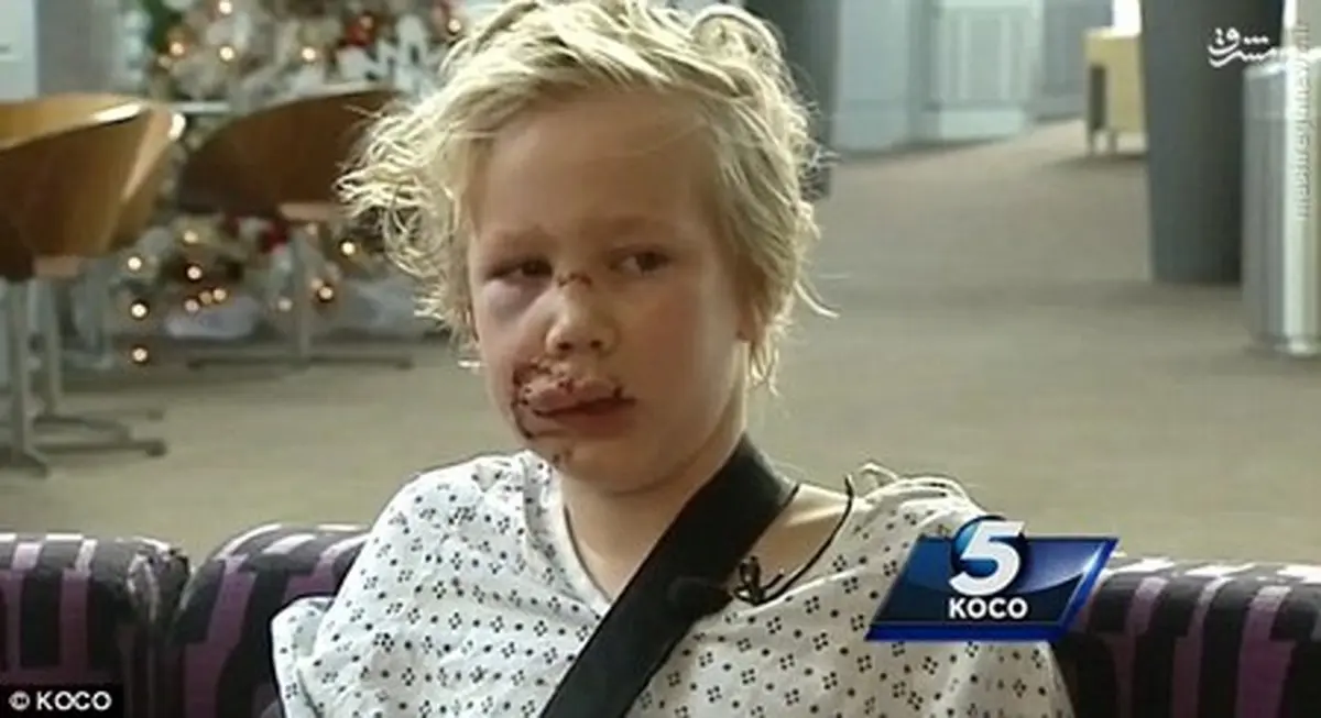 عکس/ کودکی که قربانی سگ‌ها شد