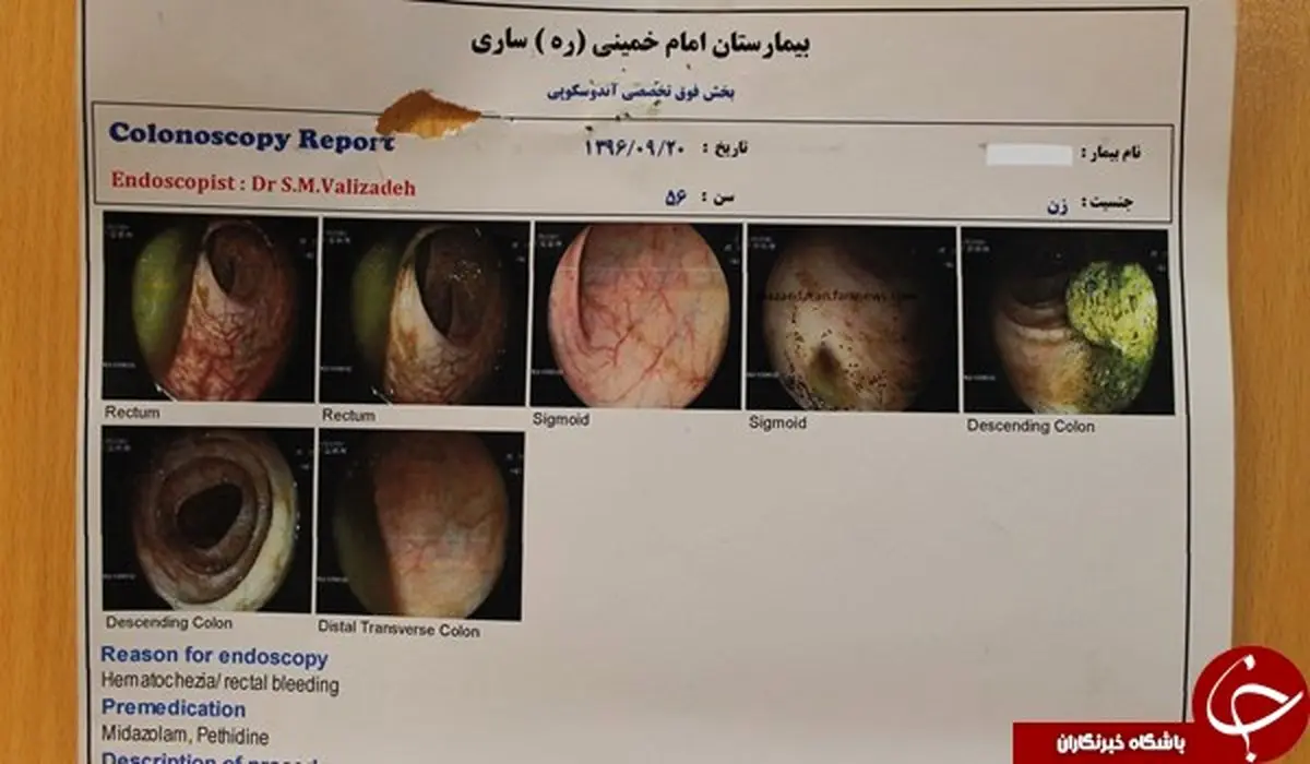 خارج کردن باند استریل از بدن یک زن 56 ساله!+ تصاویر