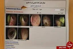 خارج کردن باند استریل از بدن یک زن 56 ساله!+ تصاویر