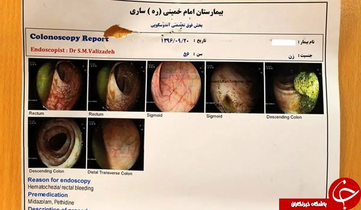 خارج کردن باند استریل از بدن یک زن 56 ساله!+ تصاویر