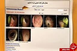 خارج کردن باند استریل از بدن یک زن 56 ساله!+ تصاویر