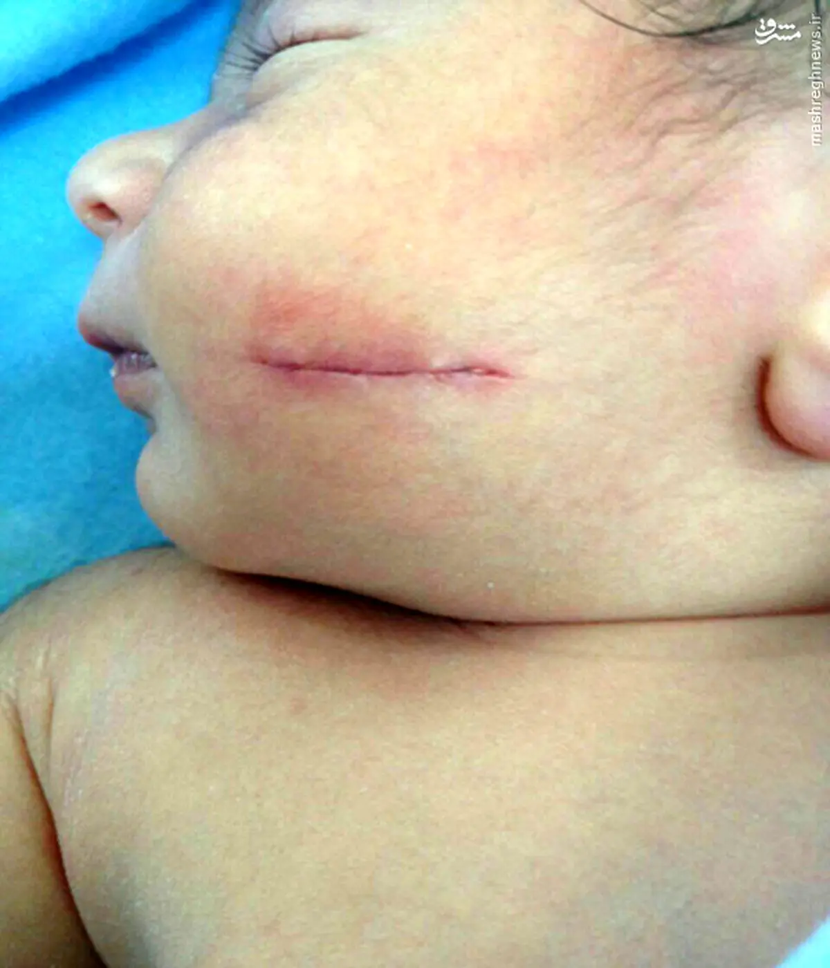 عکس/ تیغ پزشک بر صورت نوزاد