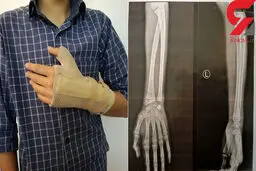 کتک خوردن وحشتناک دانش آموز 14 ساله به دست معلم قمی/ زدمش تا ادب شود!+ عکس