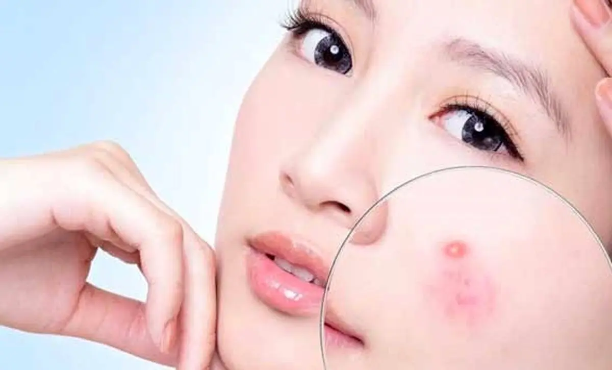 علت و درمان های خانگی جوش صورت
