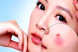علت و درمان های خانگی جوش صورت