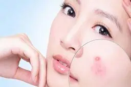 علت و درمان های خانگی جوش صورت