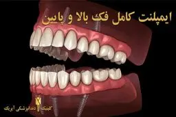 ایمپلنت کامل فک بالا و پایین  با روش ALL ON 4