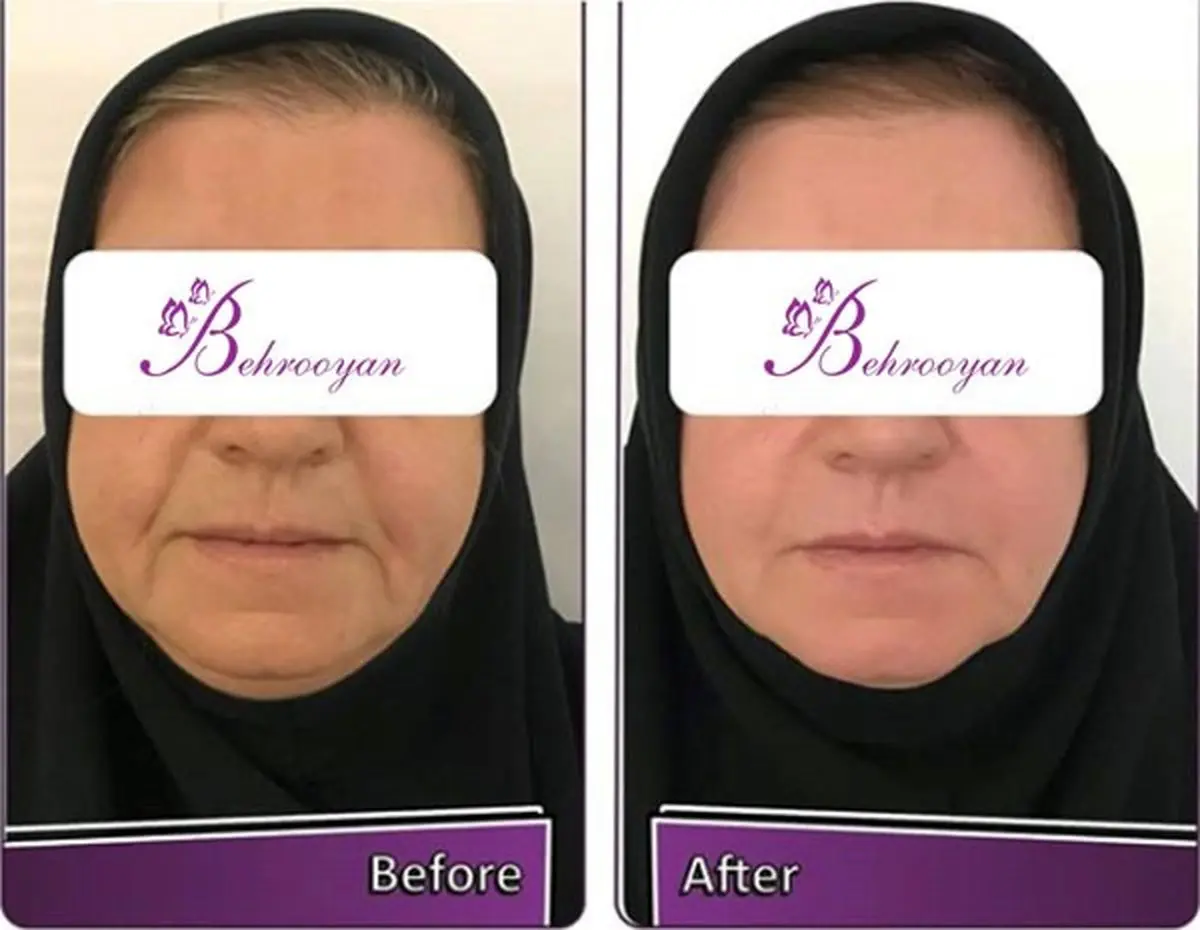 لیفت صورت با روش های غیر جراحی
