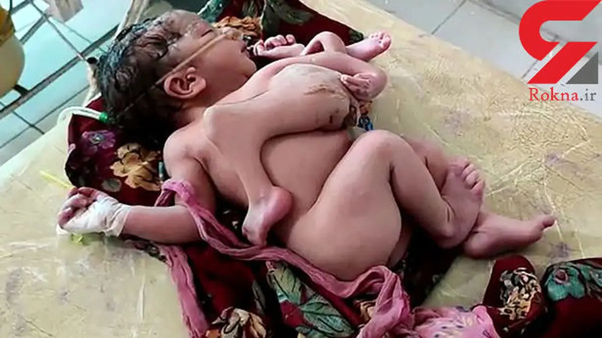 تولد نوزاد عجیب الخلقه هندی با 4 پا و سه دست+ تصویر حیرت‌آور