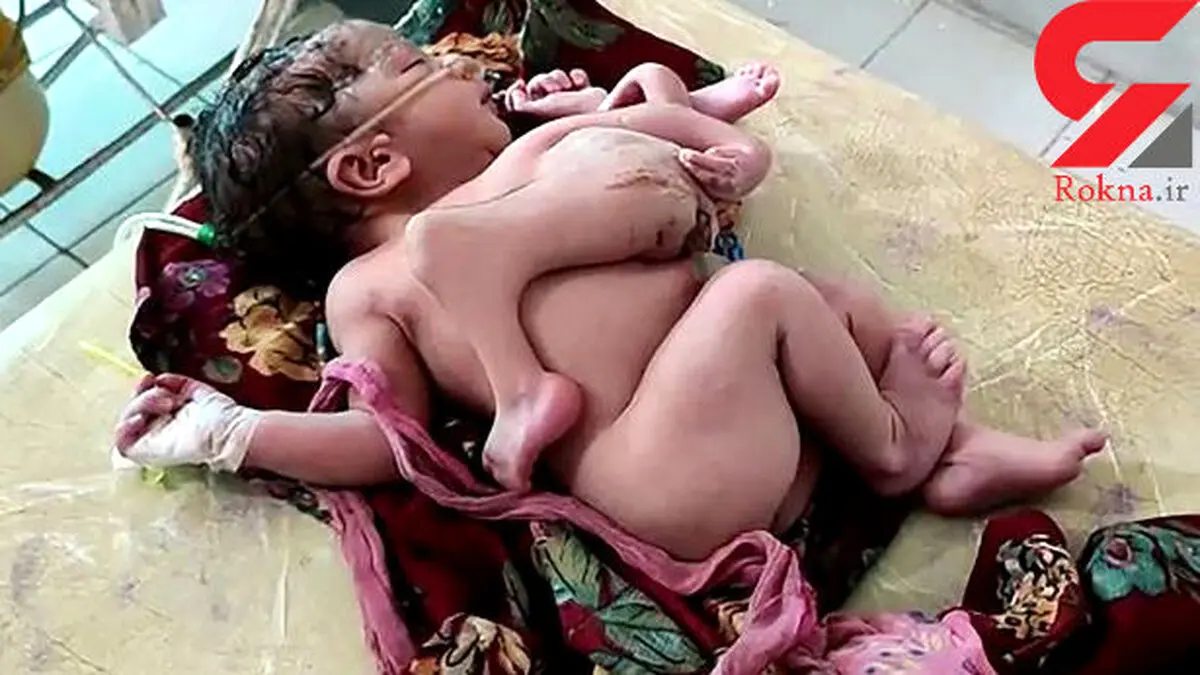 تولد نوزاد عجیب الخلقه هندی با 4 پا و سه دست+ تصویر حیرت‌آور
