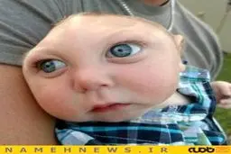 نوزادانی که مغز ندارند+11/تصاویر