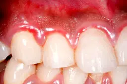 لثه هایتان به شما چه هشدارهایی درباره سلامتی تان می دهد؟