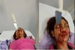 نجات معجزه آسا زنی با یک چاقو در پیشانی +عکس