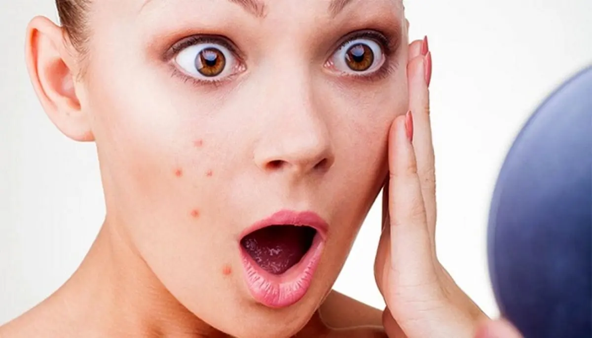 درمان جوش صورت فوری / از بین بردن جوش در یک شب با این راه حل معجزه آسا!