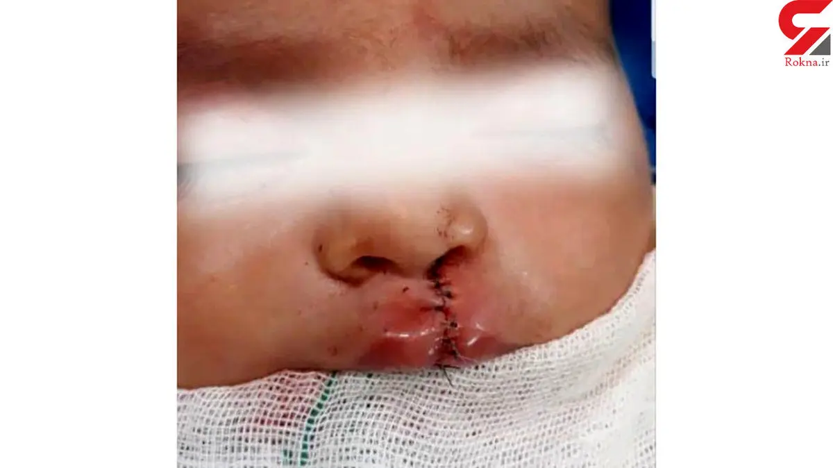 جراحی لب شکافته کودک 4 ماهه در سراوان + عکس تکاندهنده