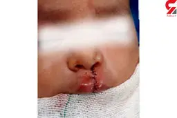 جراحی لب شکافته کودک 4 ماهه در سراوان + عکس تکاندهنده