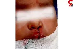 جراحی لب شکافته کودک 4 ماهه در سراوان + عکس تکاندهنده