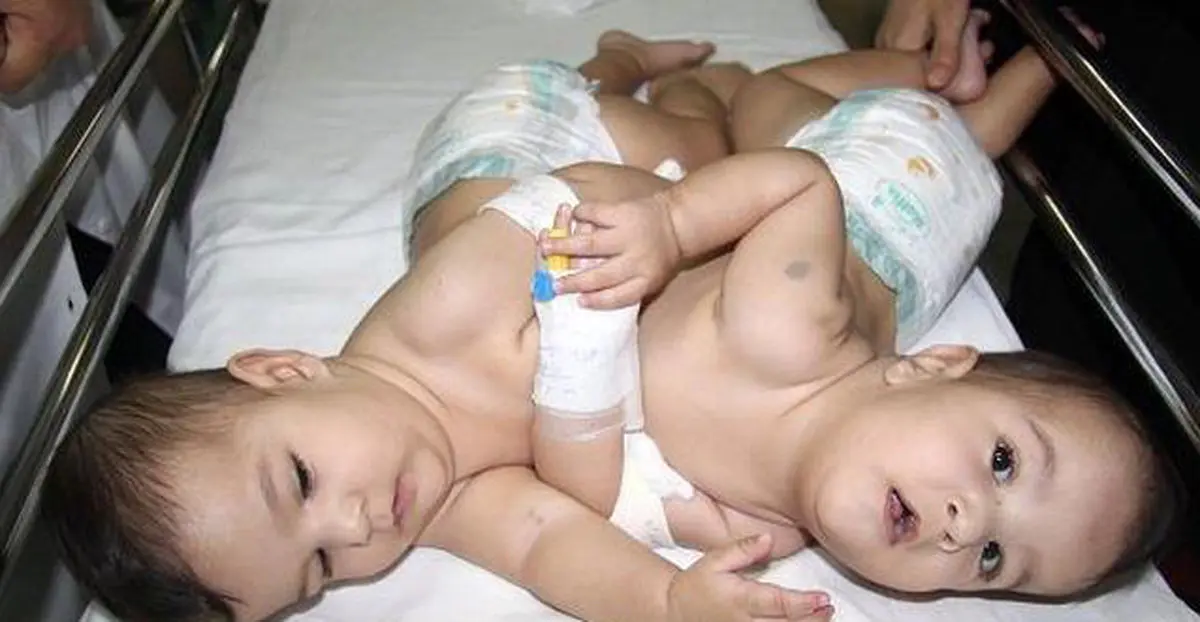 جراحی باورنکردنی در شیراز حال محمد و رضا خوب است ! + عکس ها