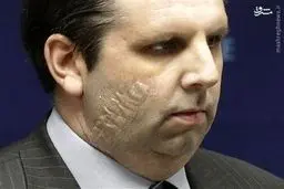 ۸۰  بخیه بر روی صورت سفیر آمریکا/عکس