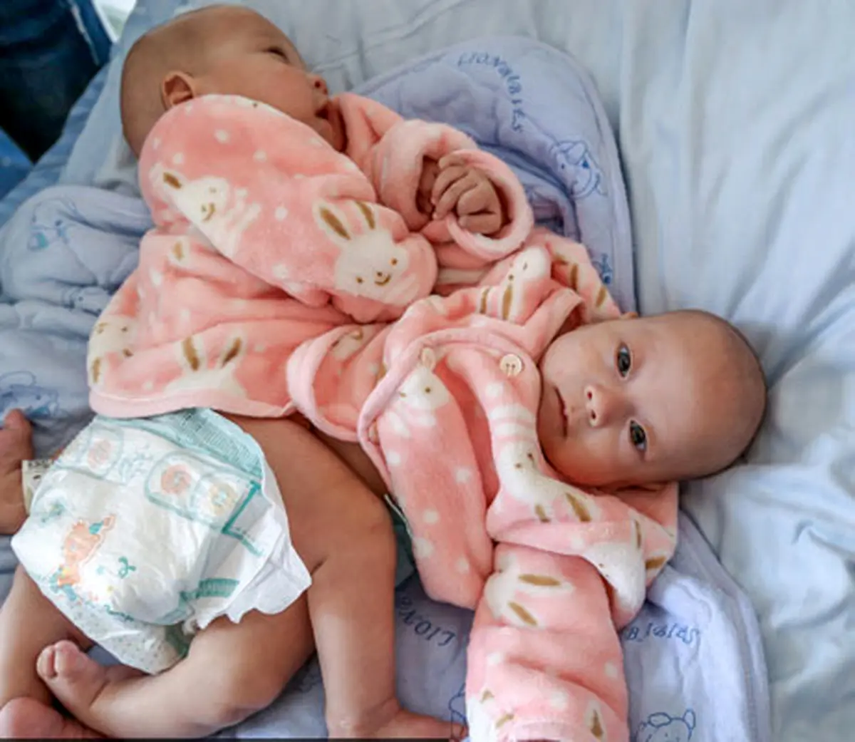 تصاویر/ جدا‌سازی دو‌قلوهای چینی