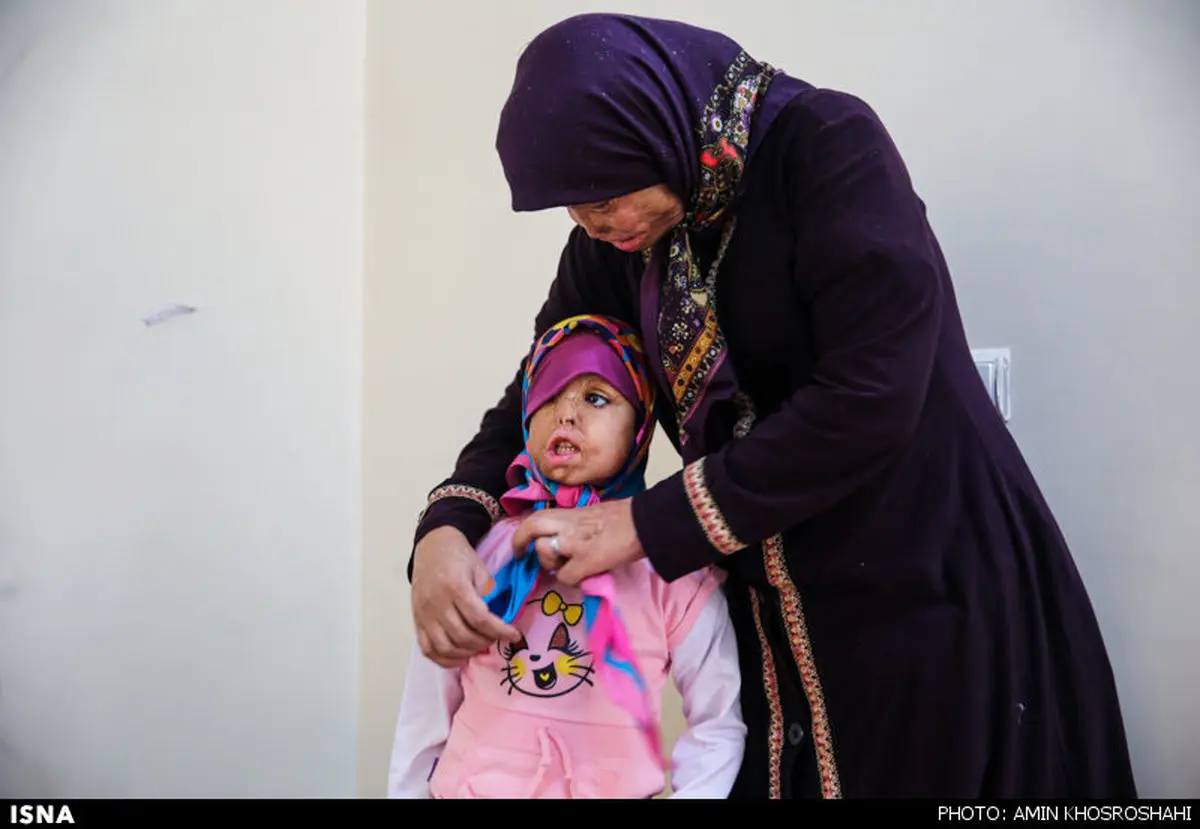 مرگ زن قربانی اسیدپاشی در بیمارستان+عکس