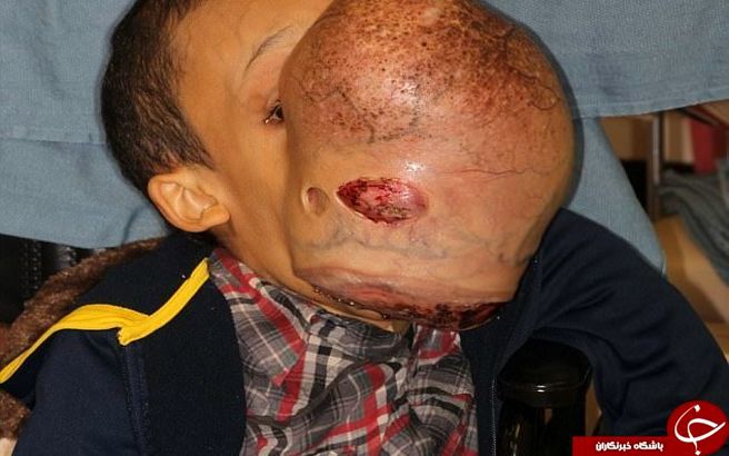 جراحی تومور عجیب صورت پسر 14 +تصاویر