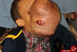 جراحی تومور عجیب صورت پسر 14 +تصاویر