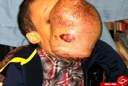 جراحی تومور عجیب صورت پسر 14 +تصاویر