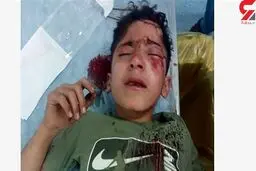 جدیدترین خبر از کولبر 14 ساله که جلوی چشمان مادرش به شدت زخمی شد