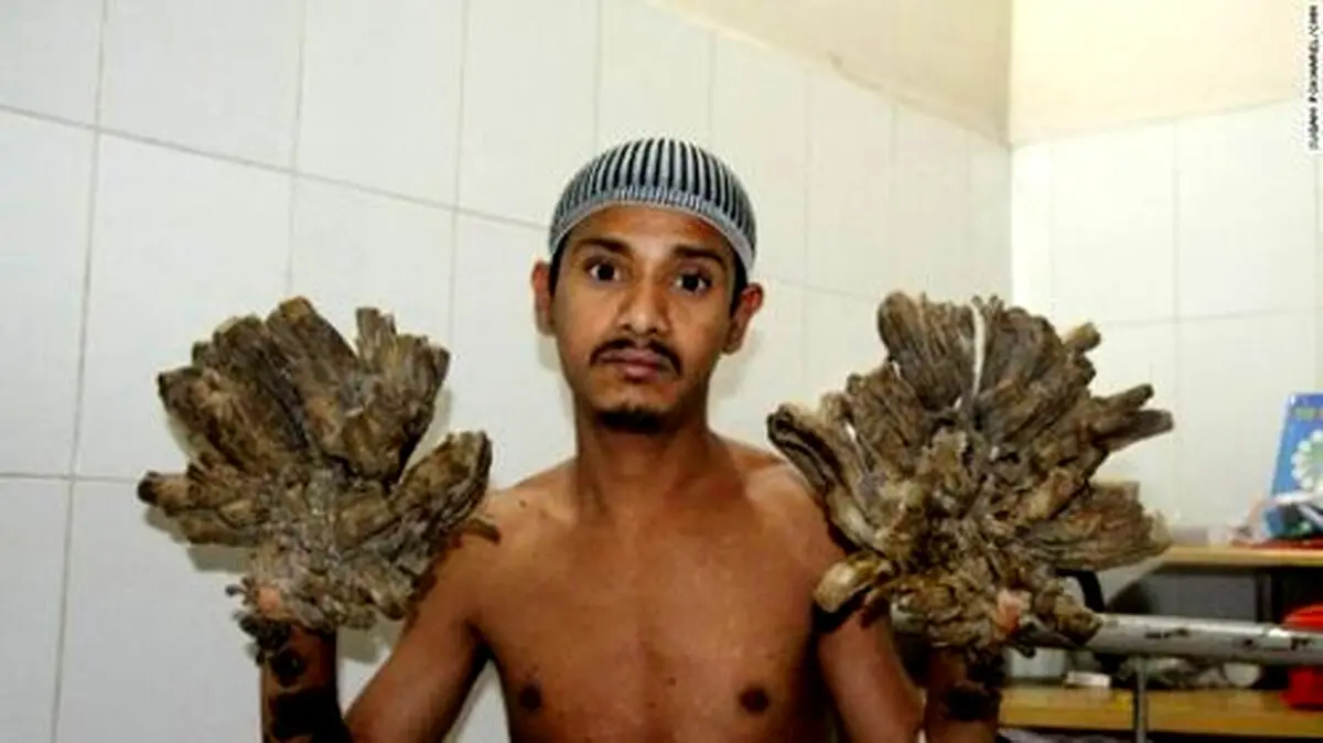 مرد درختی جراحی شد/ عکس