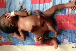 تولد نوزادی با 8 دست‌ و‌ پا + عکس