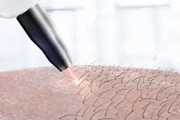فناوری لیزر در حذف موهای زائد و بررسی بهترین لیزر مو در ایلام
