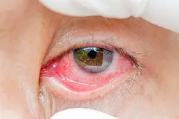 قرمز شدن چشم‌ها؛ از علت تا درمان