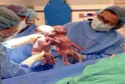 دوقلوهایی که تا به دنیا آمدن دستان یکدیگر را ول نکردند/عکس