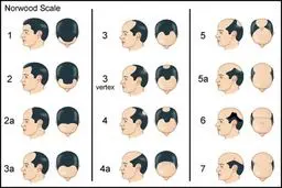 علت ریزش مو در مردان و درمان آن