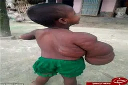 بیماری عجیب و نادر کودک 2 ساله +تصاویر