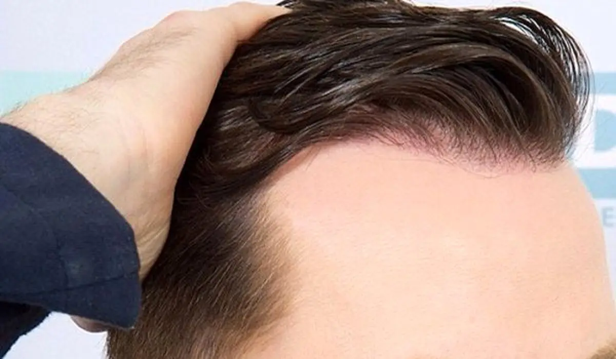 حقایق مهم درباره روش های کاشت موی طبیعی