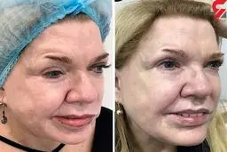 عکس باورنکردنی از تغییر قیافه یک زن با تزریق بوتاکس