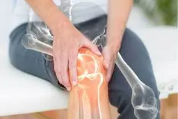 نسخه خانگی برای تسکین درد آرتروز زانو

