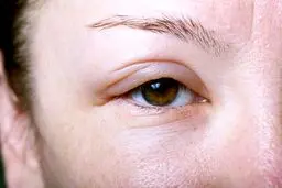 دلایل پف‌آلودی صورت در صبح‌ها