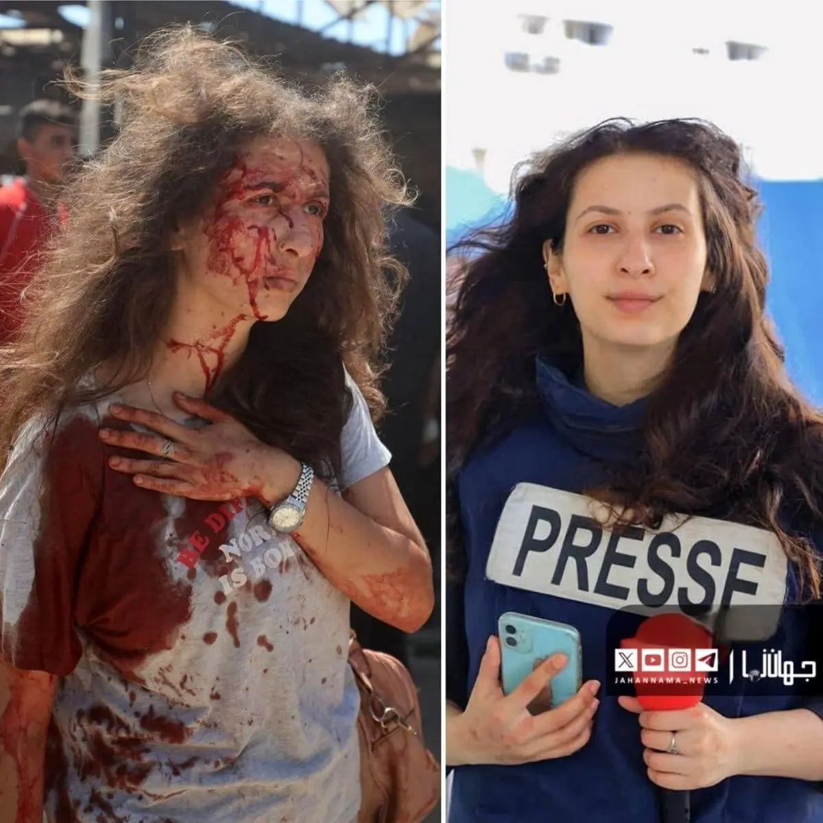 چهره خونین خبرنگار زن فلسطینی بعد از بمباران اسرائیل 