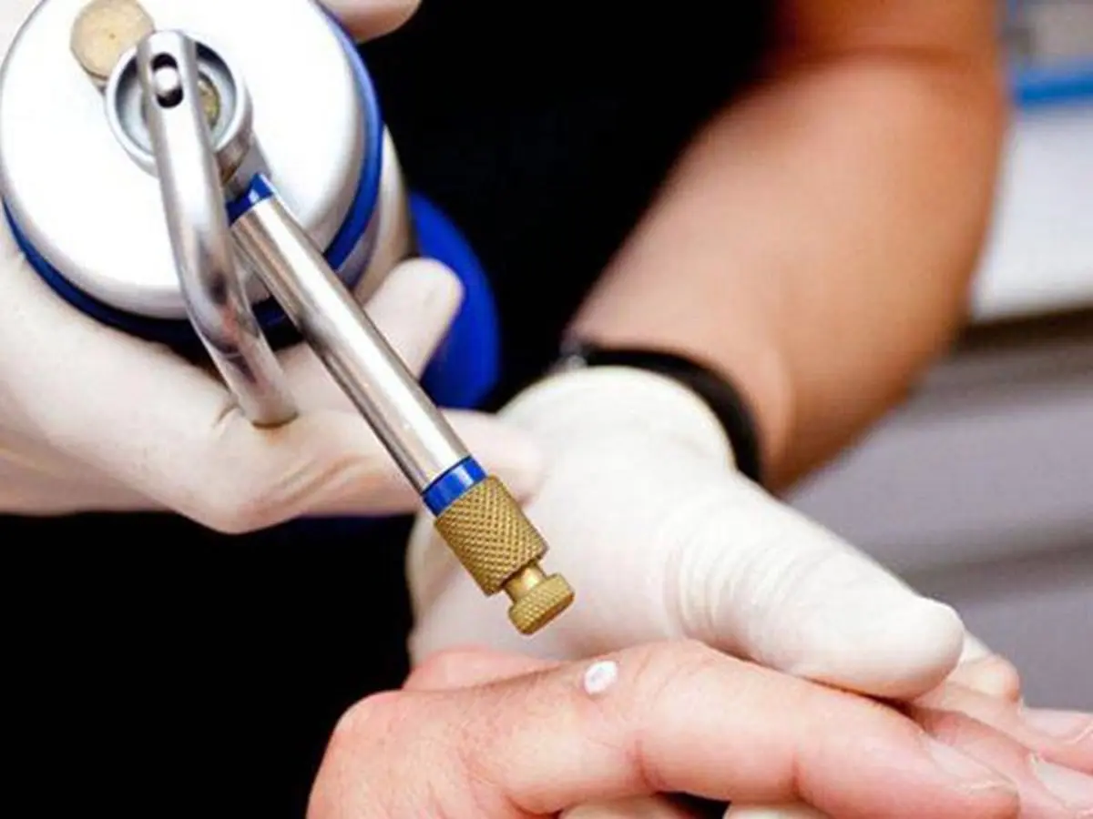 درمان زگیل تناسلی با لیزر یا کرایو؟ کدام بهتر است؟
