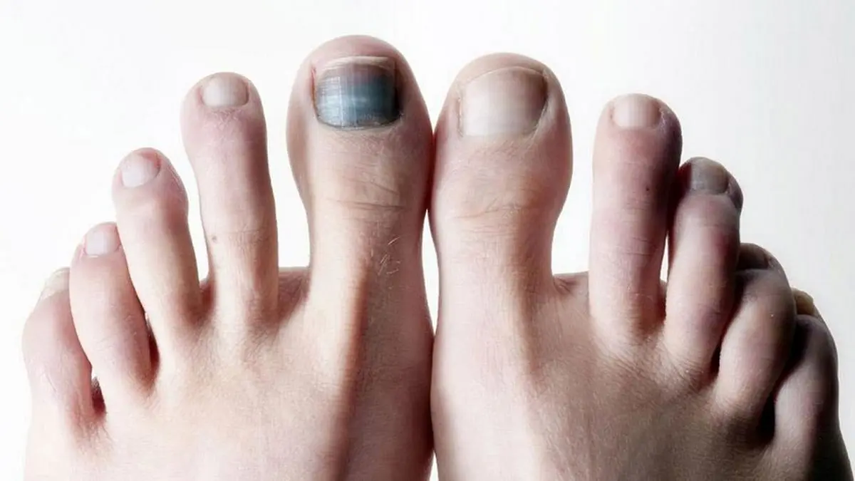 علت سیاه شدن ناخن پا و راه درمان