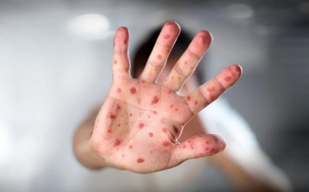 هشدار وزارت بهداشت درباره شیوع سرخک/ فراخوان واکسیناسیون کودکان زیر ۵ سال