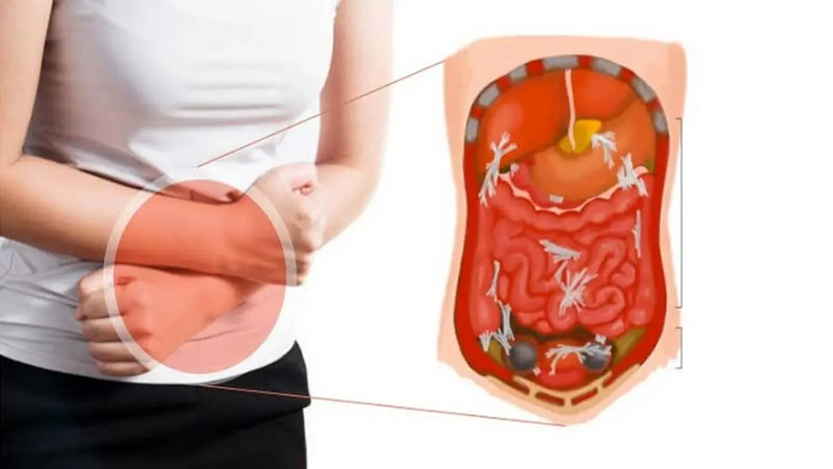 انسداد روده بزرگ؛ علائم، علت ها و درمان