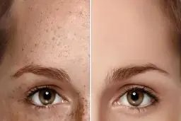 اثرات لیزر کیوسوییچ روی پوست