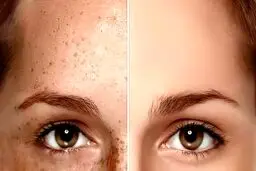 اثرات لیزر کیوسوییچ روی پوست