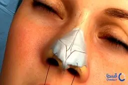 پرداخت هزینه عمل بینی اقساطی و دندانپزشکی قسطی